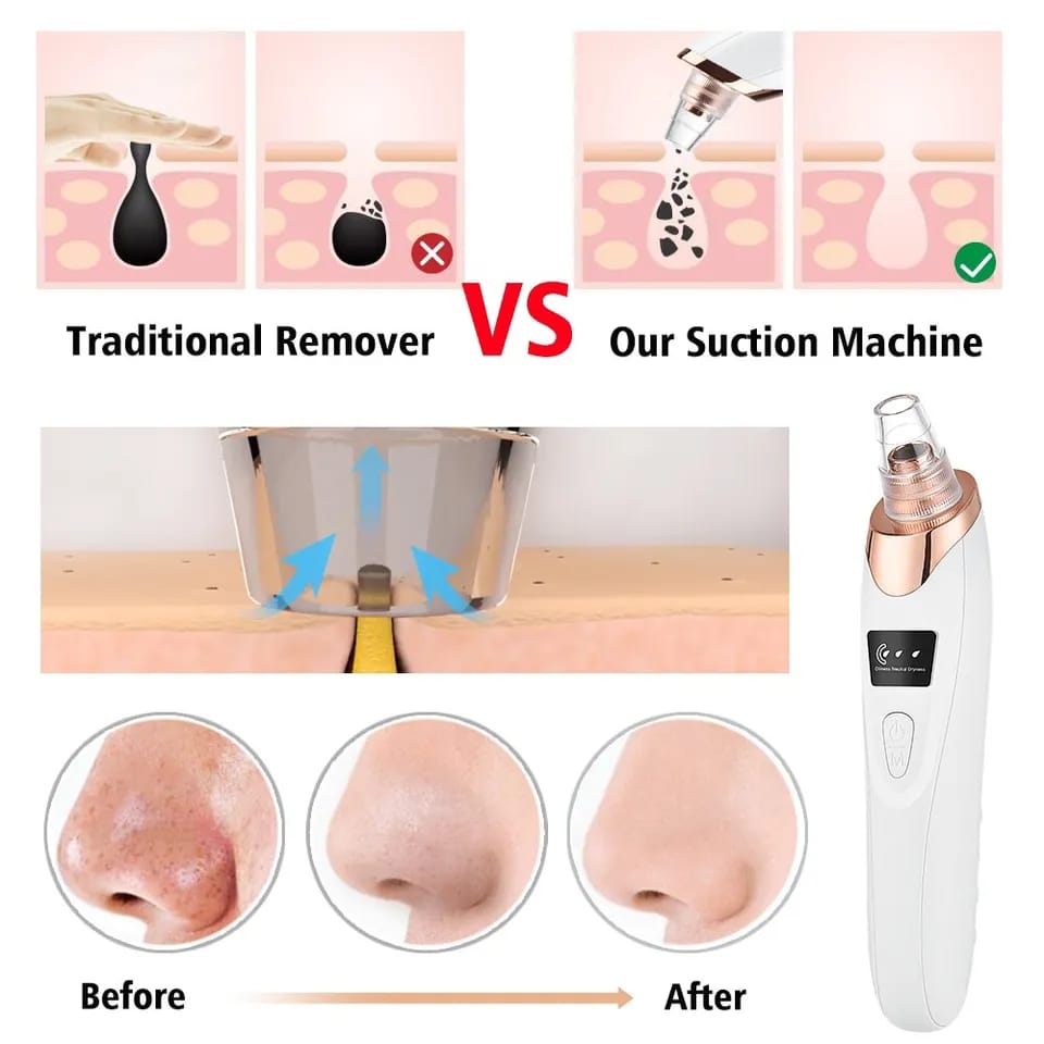 Vacuum Blackhead Remover For Pore Acne Pimple Removal and Vacuum Suction Facial Pore Cleaner
